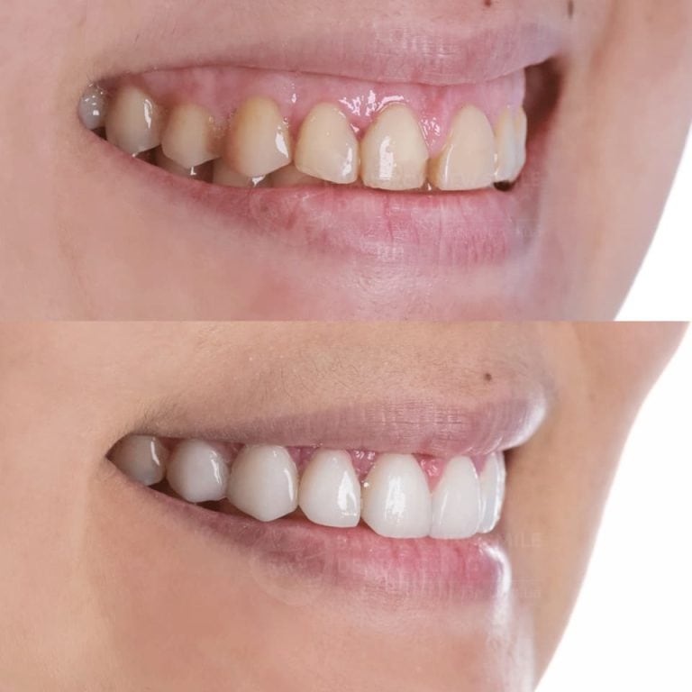 เซรามิกวีเนียร์