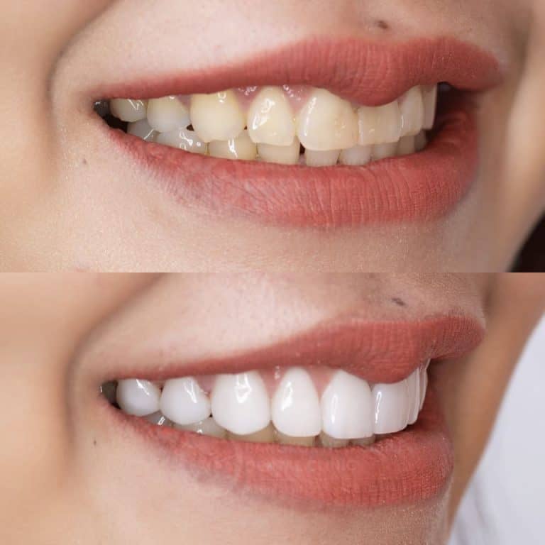 Ceramic Veneer