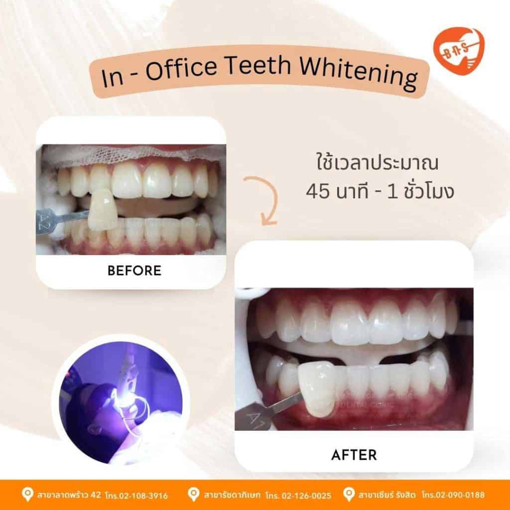 InOffice Teeth Whitening คลินิกทันตกรรม Bangkok New Smile