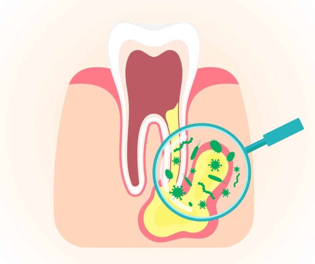 Root Canal Treatment - คลินิกทันตกรรม Bangkok New Smile